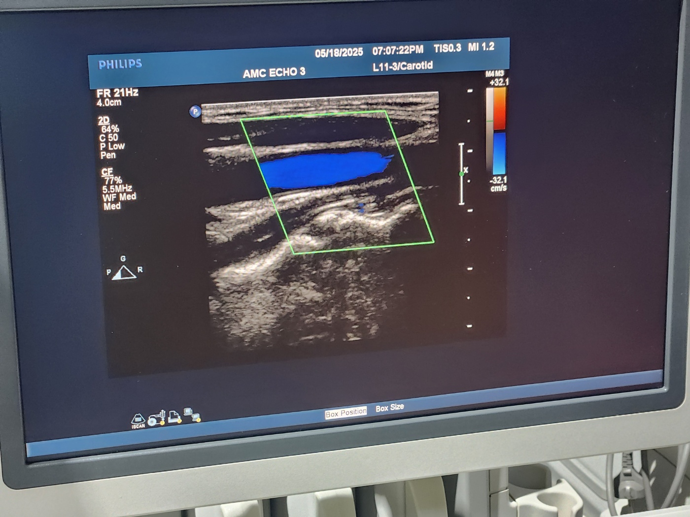 Philips IU33 Ultrasound Machine
