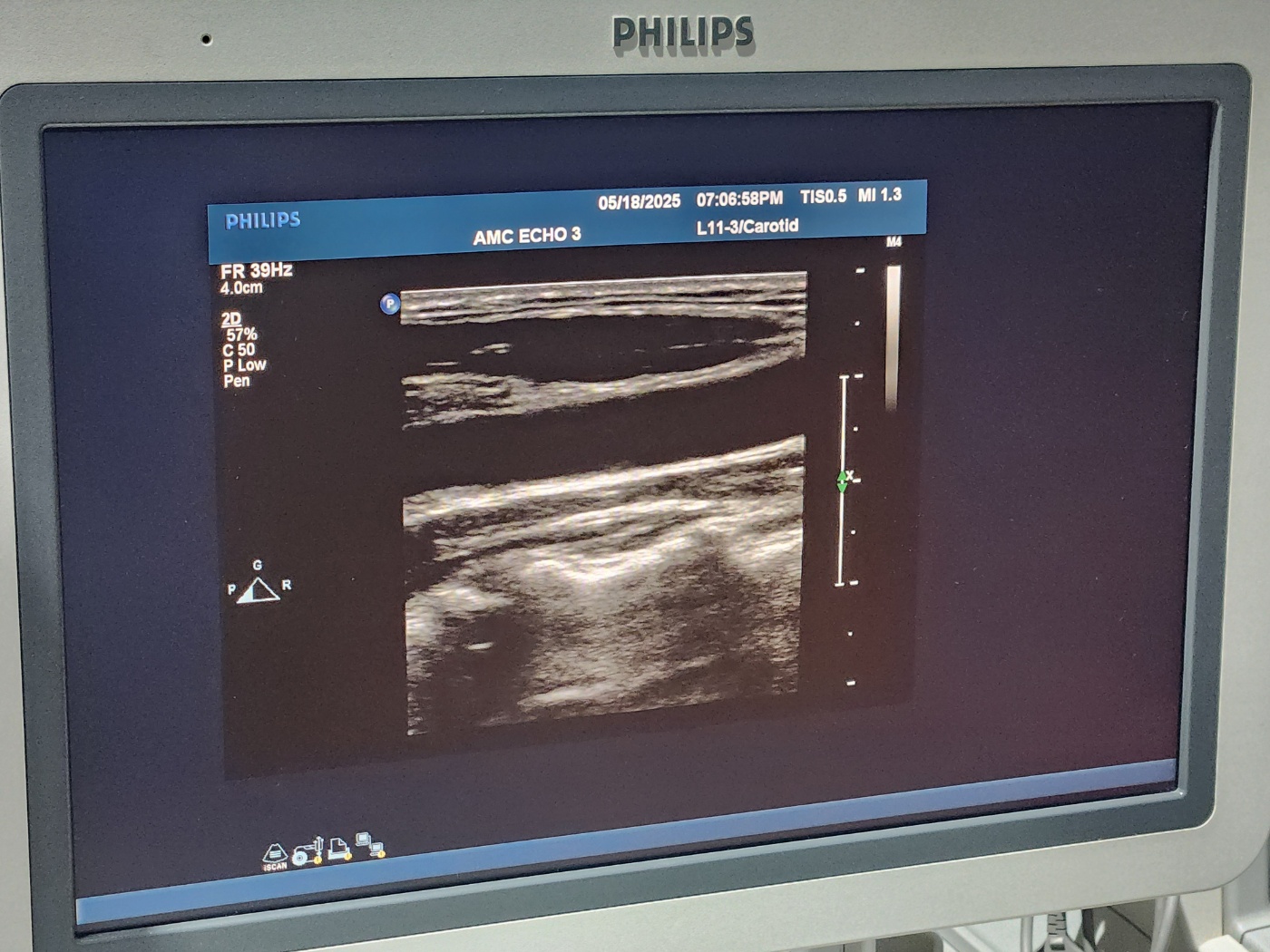Philips IU33 Ultrasound Machine