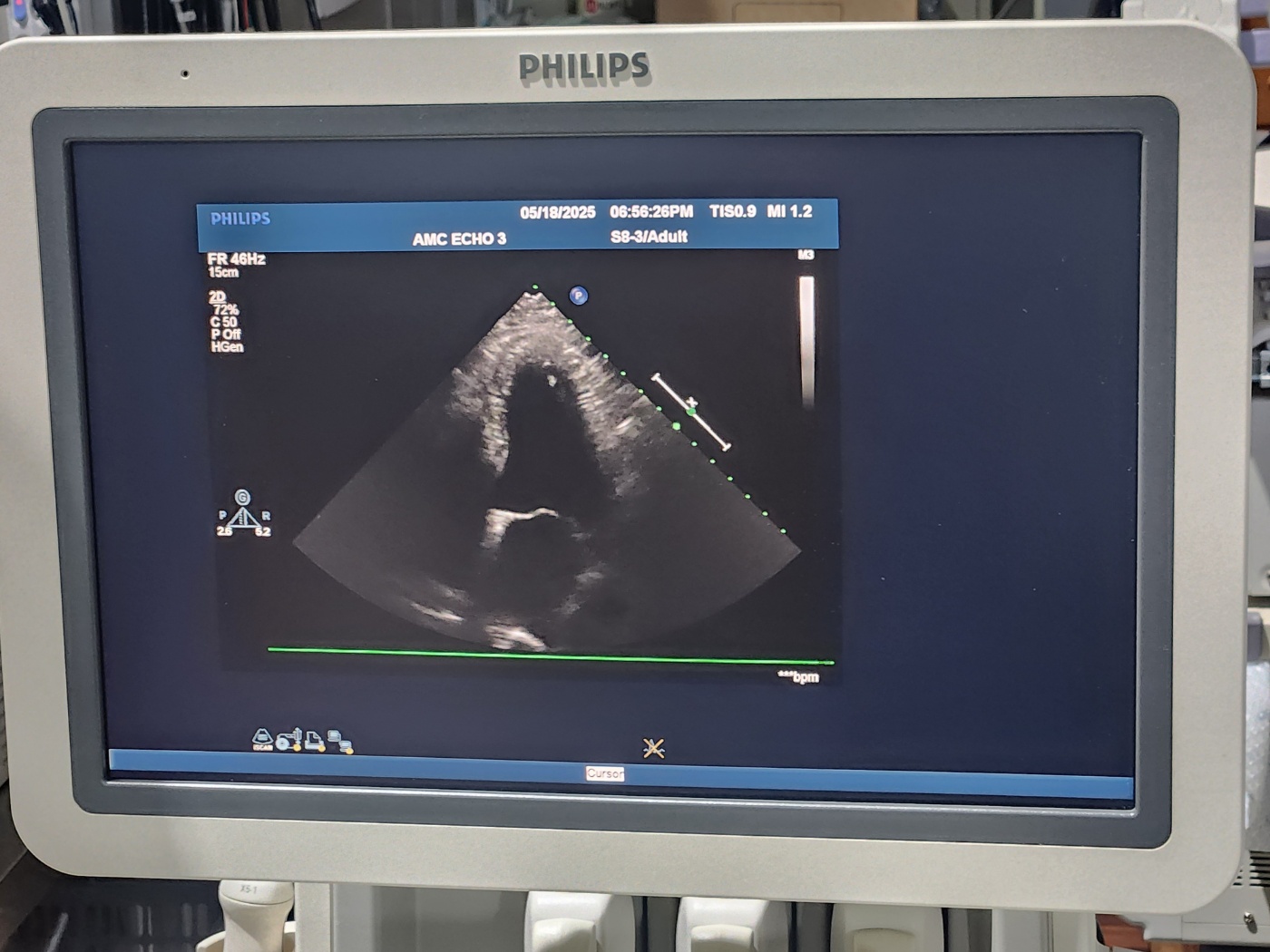 Philips IU33 Ultrasound Machine