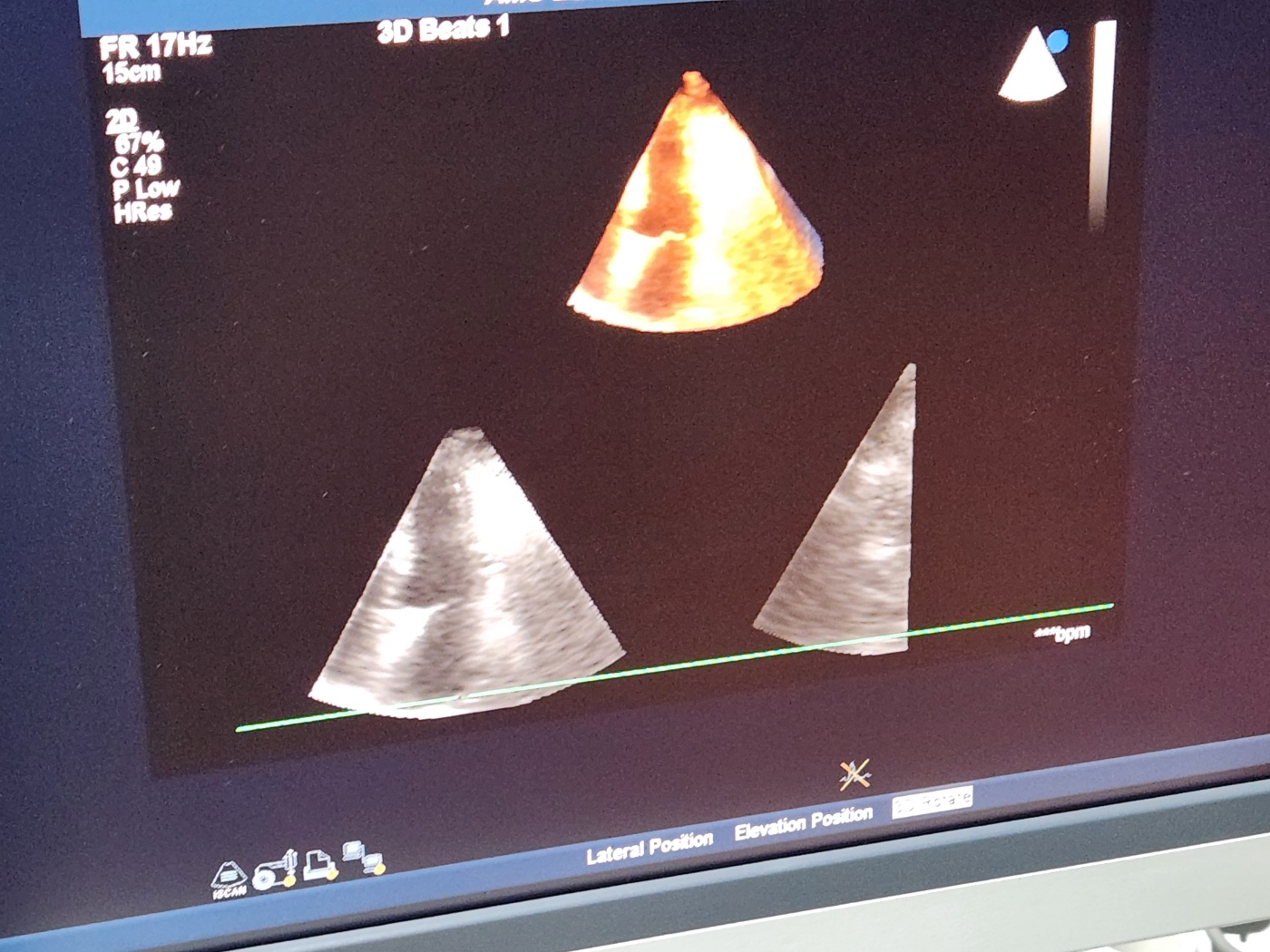 Philips IU33 Ultrasound Machine