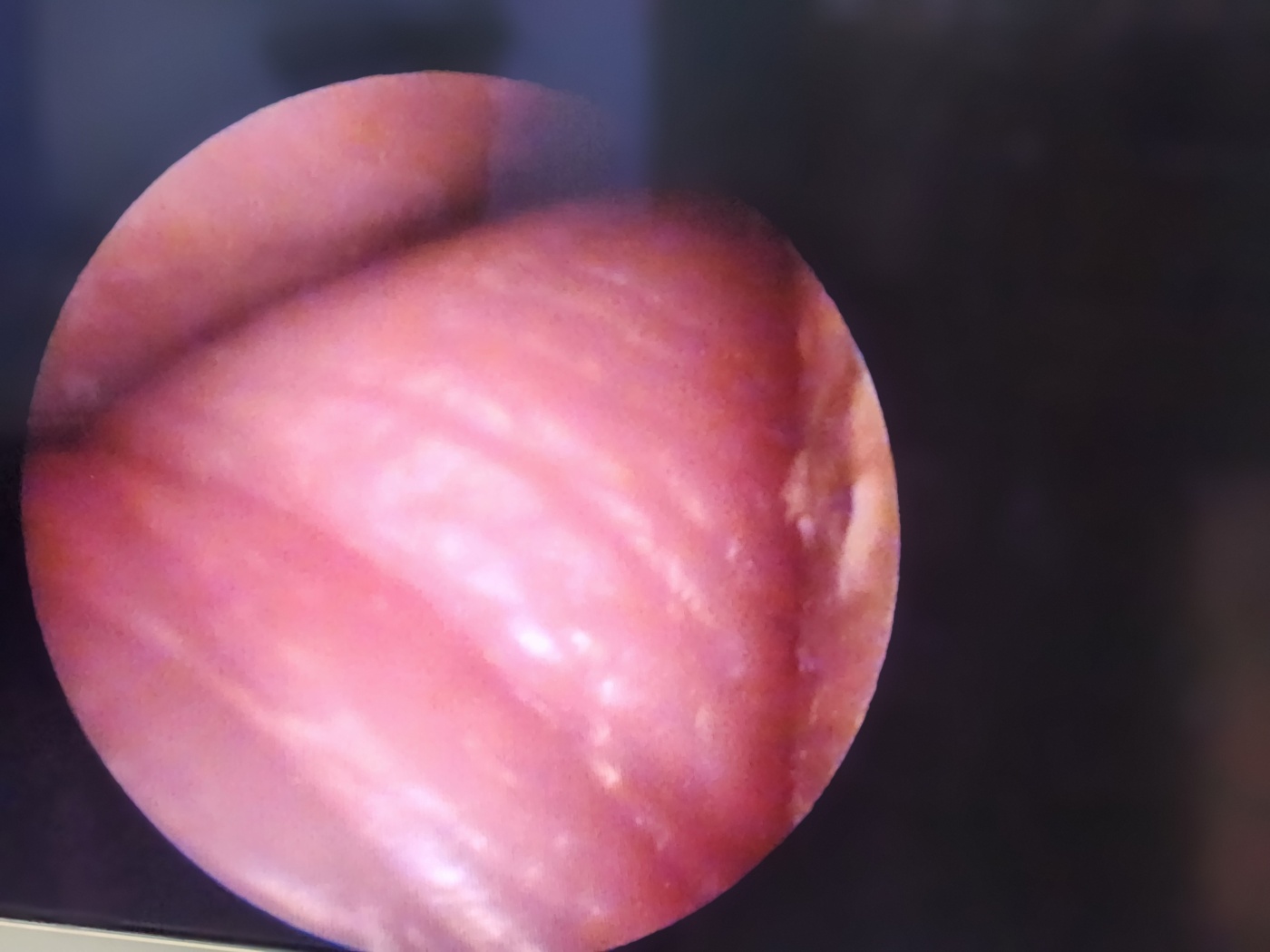 Richard Wolf  Panoview  RIGID ENDOscope