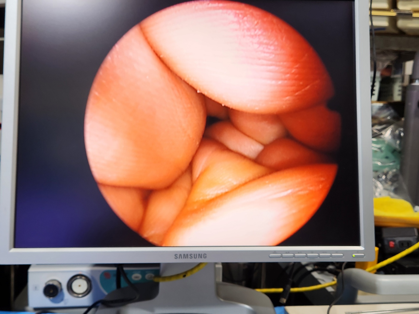 Lawton   Rigid Endoscope (Clear View)