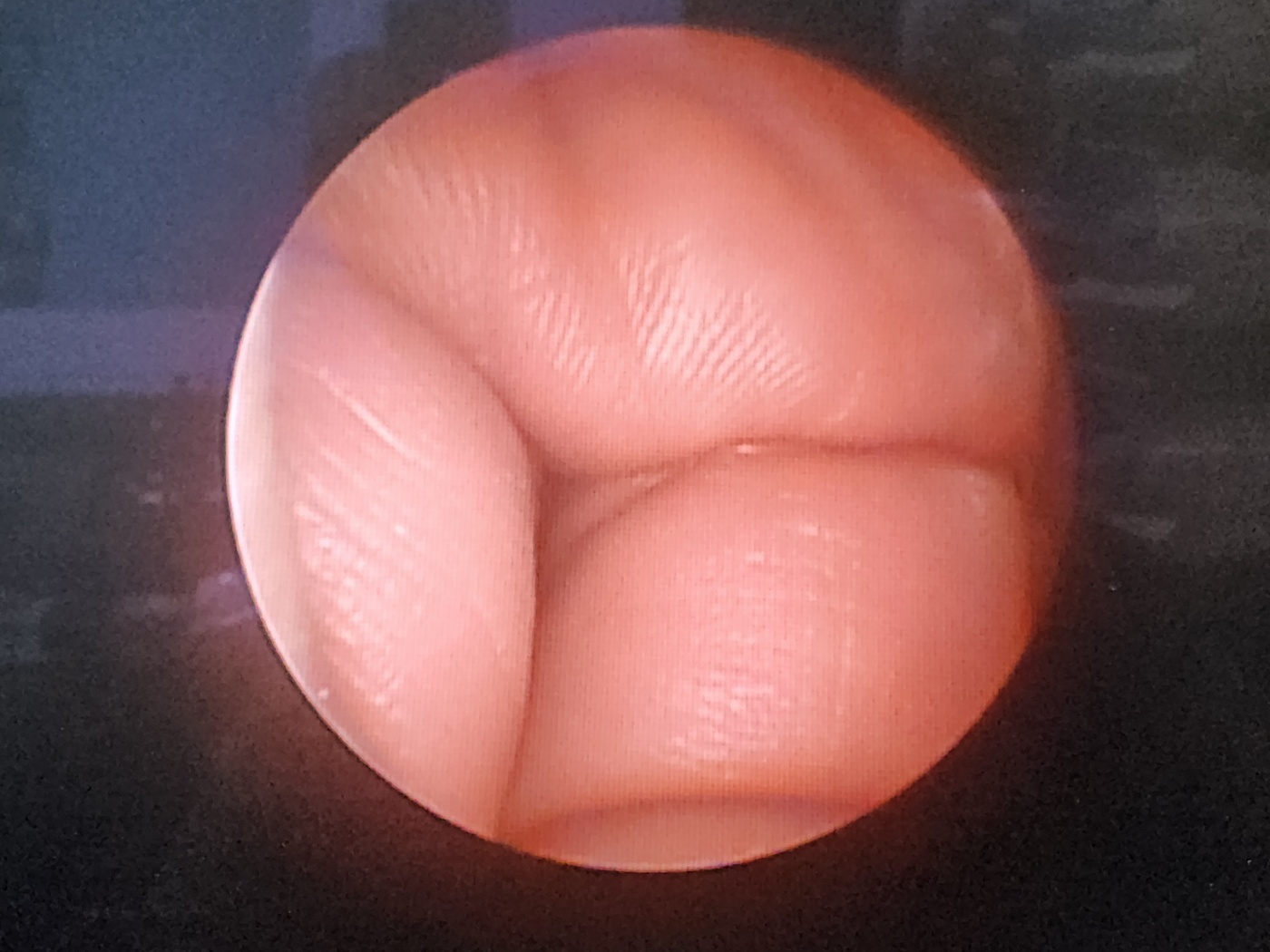 Karl Storz Hopkins Telescope