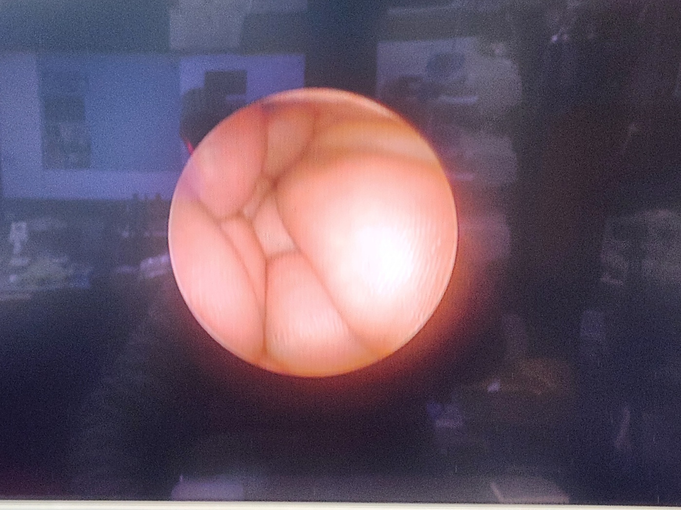 Karl Storz Hopkins Telescope