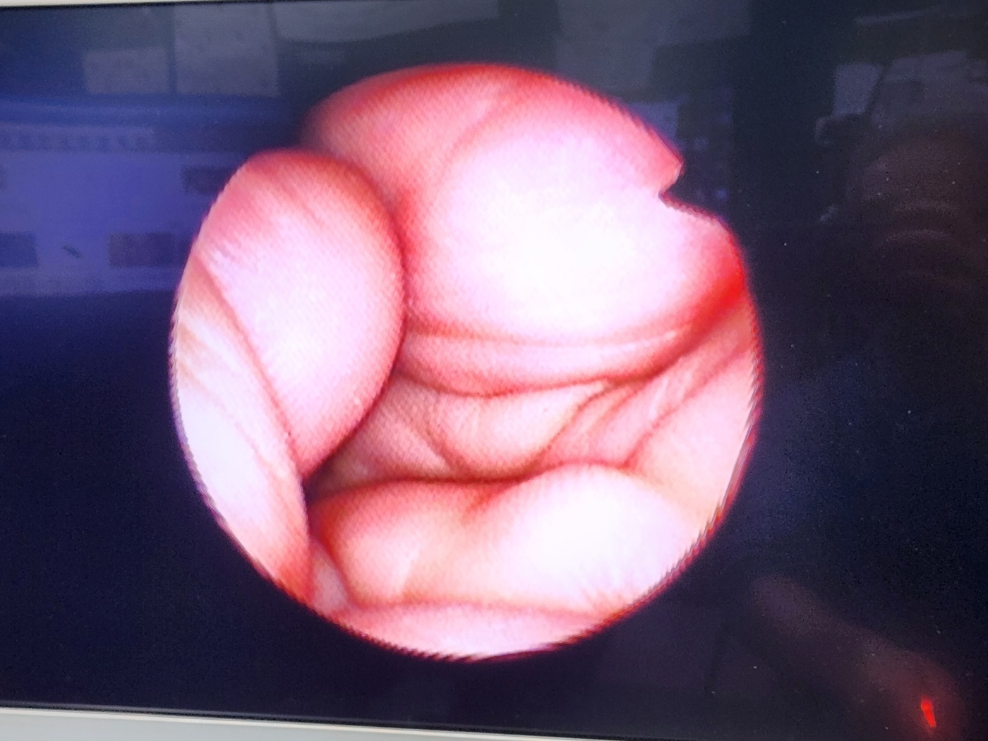 Olympus ENF-P4  Rhino  Laryngoscope