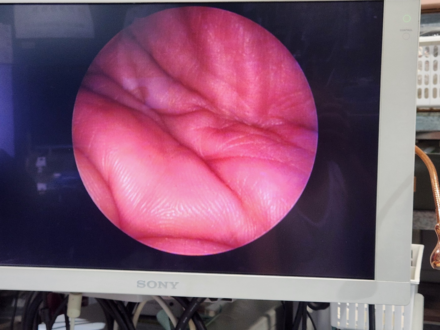 KARL STORZ  HOPKINS   28132AA  Neuro-Endoscopy