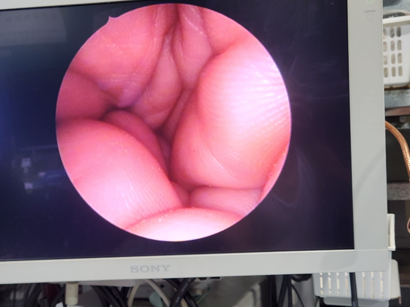 KARL STORZ  HOPKINS   28132AA  Neuro-Endoscopy