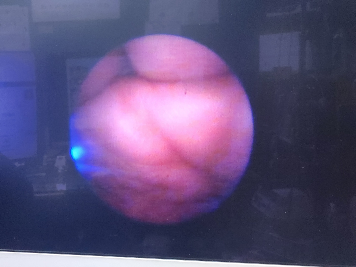 Imagyn MicroLap ML-Gold Cystoscope