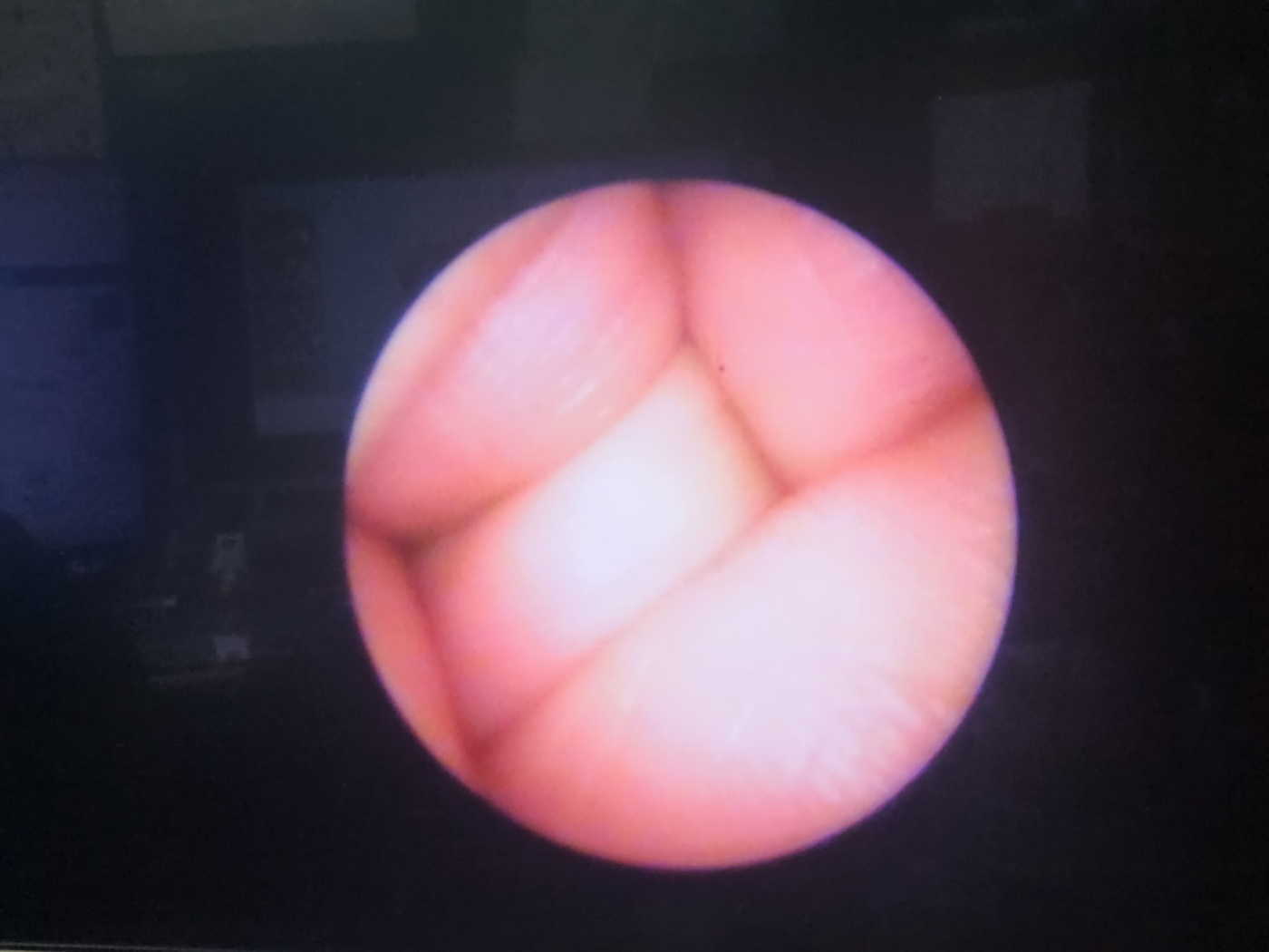 Imagyn MicroLap ML-Gold Cystoscope
