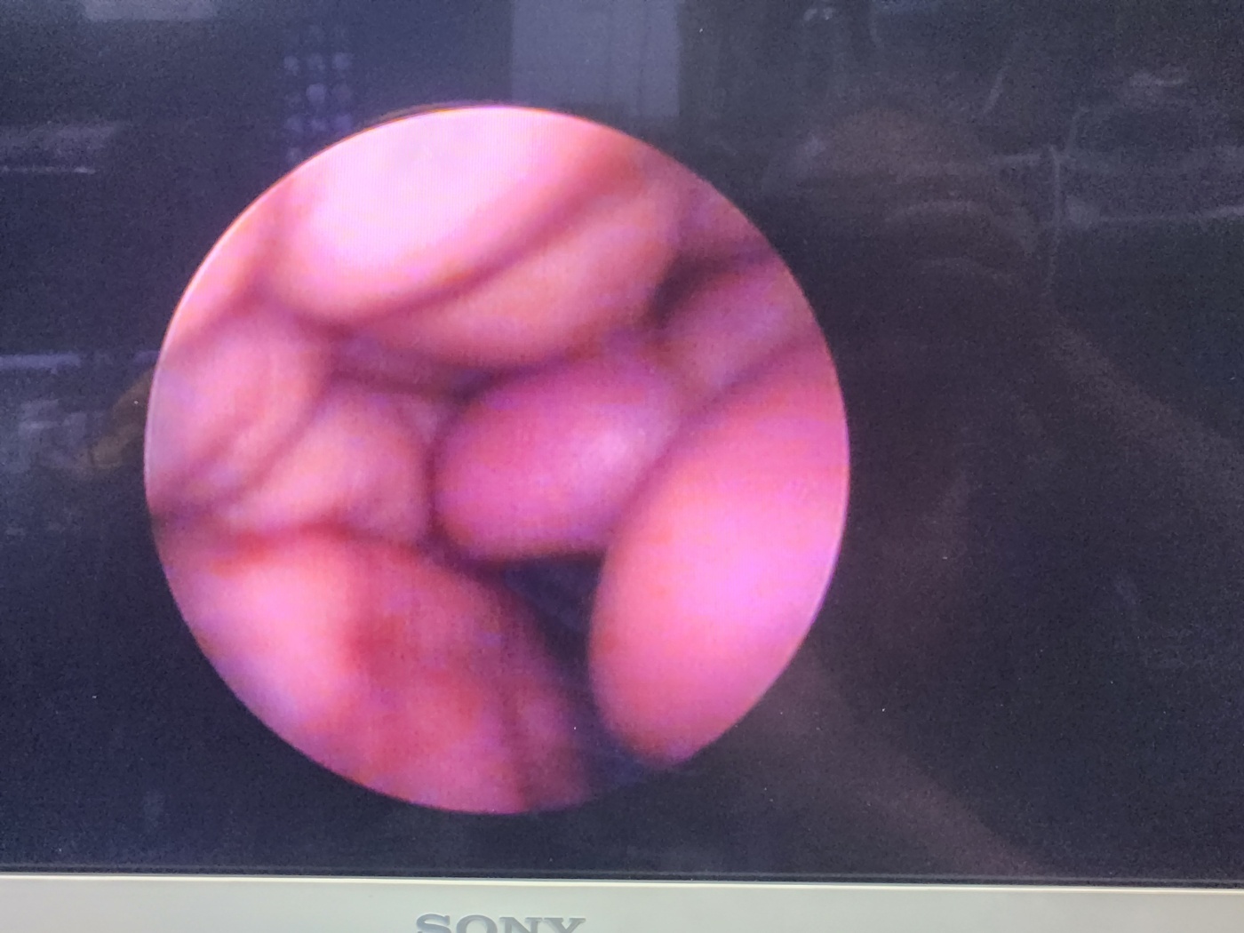 Aesculap PE204A neuroendoscope  MINOP endoscope